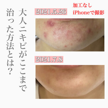 スキンケア方法 ロゼット 洗顔パスタ 荒性肌 ロゼットの使い方 効果 大人ニキビが治った方 By ベビー 敏感肌 30代前半 Lips