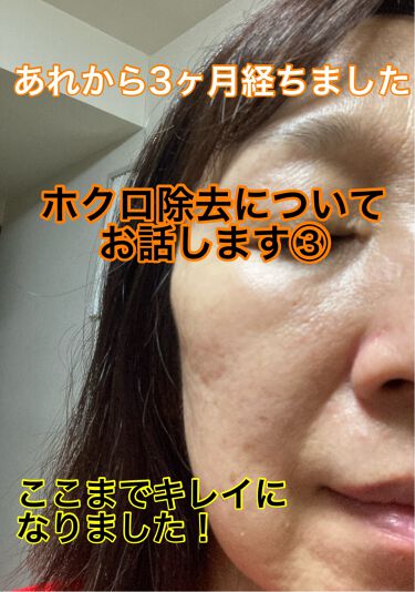 薬用クリアローション ネイチャーコンクを使った口コミ ホクロ除去して3ヶ月が経ちました ホクロが By どえり 乾燥肌 50代後半 Lips