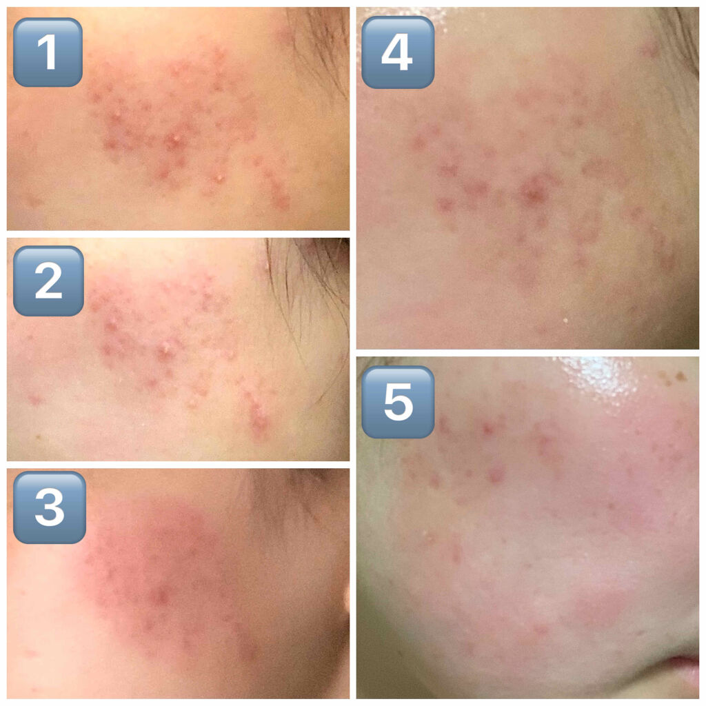 ベピオゲル 医薬品 の口コミ ベピオゲル 使用経過 副作用について5月 By 乾燥肌 Lips