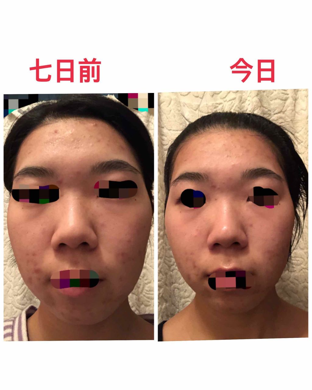 はとむぎ美肌マスク はとむぎ本舗の口コミ 乾燥肌におすすめのシートマスク パック 良くも悪くもない笑良い By はるか 脂性肌 代前半 Lips