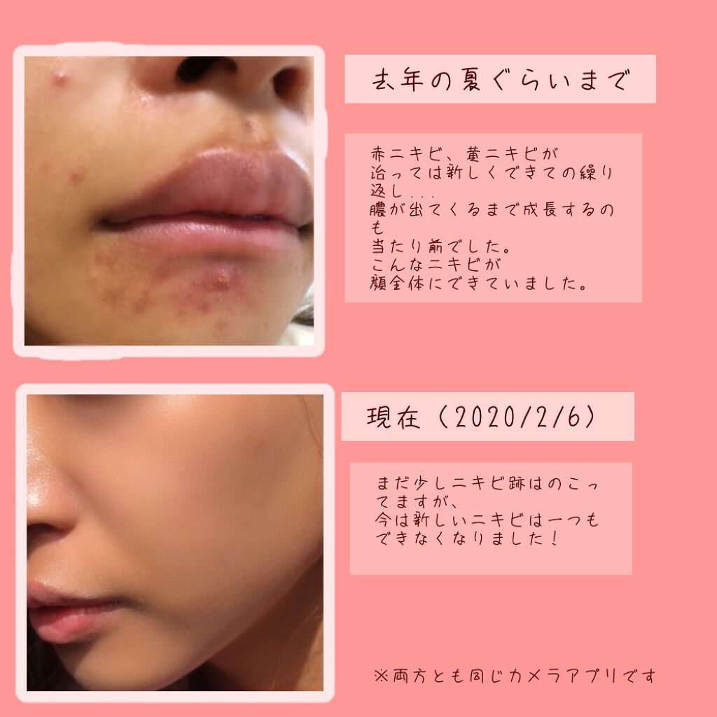 マデカソ Cica化粧水 A Pieuを使った口コミ ニキビ肌改善スキンケア こんばんは By ゆんゆん 普通肌 代前半 Lips