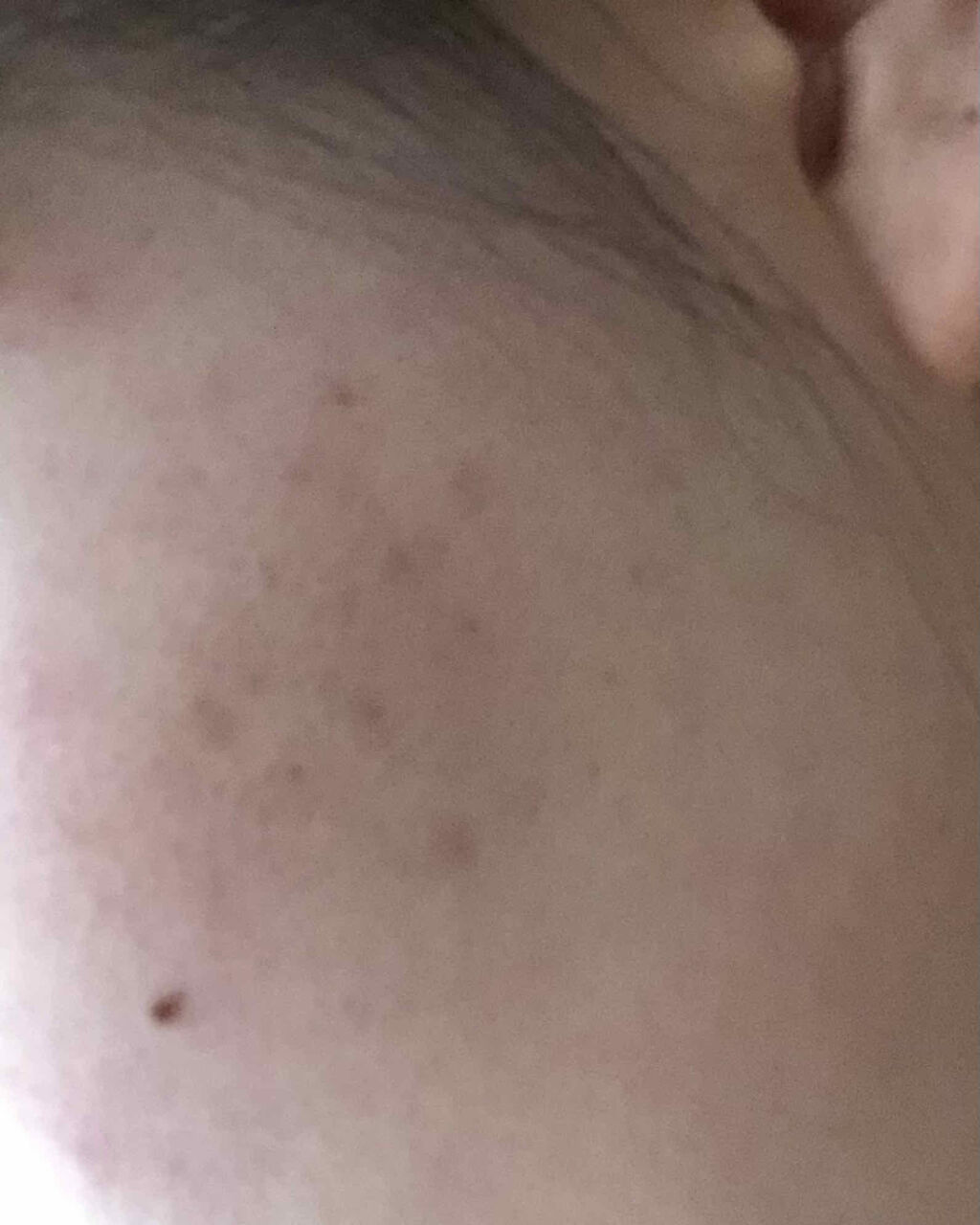 オロナインｈ軟膏 医薬品 オロナインの口コミ ニキビ日記 オロナイン軟膏を使い始め By さくらんぬ 脂性肌 Lips