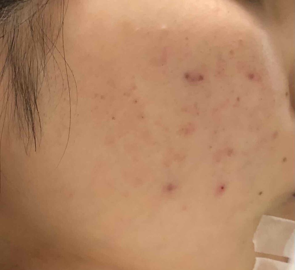 オロナインｈ軟膏 医薬品 オロナインを使った口コミ にきび撲滅 美肌計画ダイエットと一緒にニキ By きなこ 敏感肌 代前半 Lips