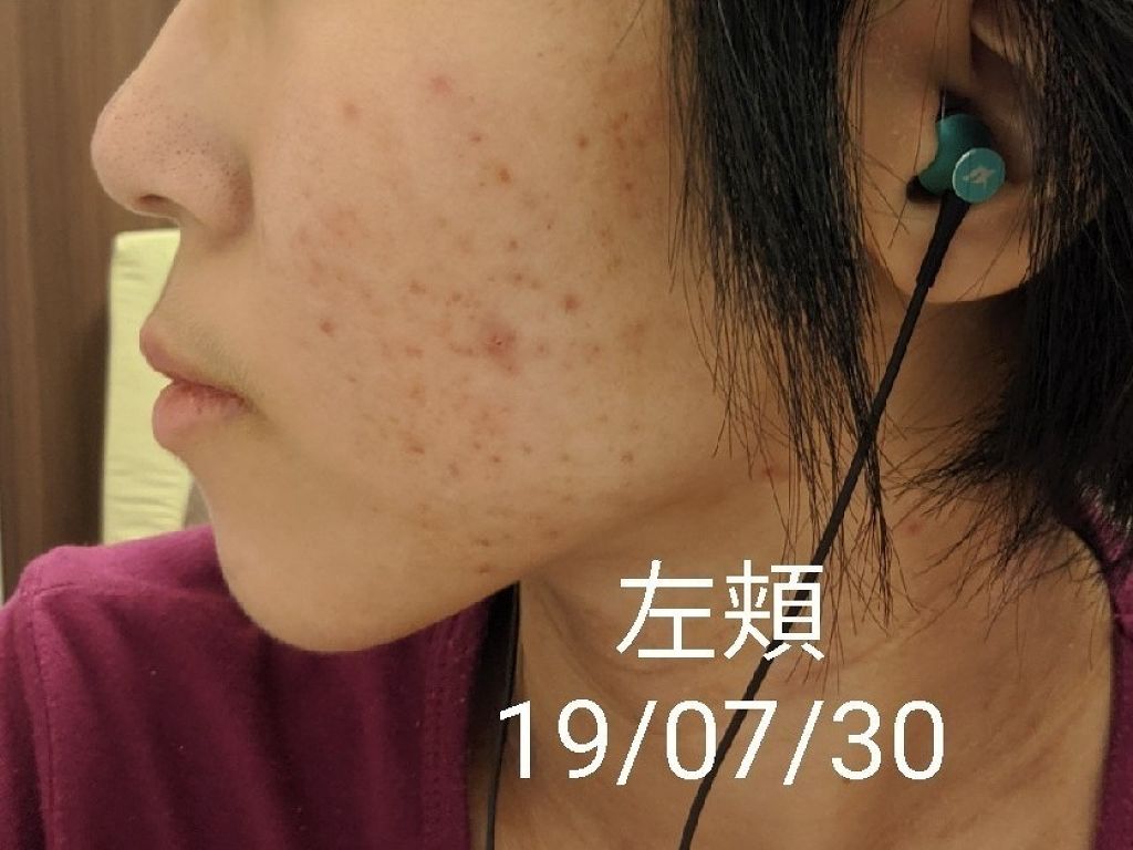 お肌断食水ローション オリエンの使い方を徹底解説 しつこいニキビって本当にイライラしませんか By はろ アトピー肌 代前半 Lips