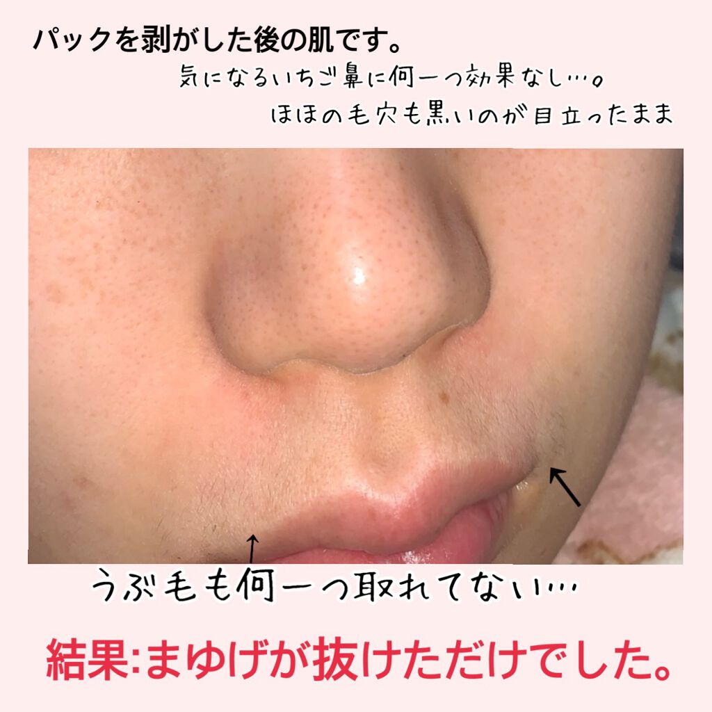 がばいよか剥がすパック 炭黒 アスティ コスメフリークの辛口レビュー 毛穴写真有り 閲覧注意 がばいよ By ばにらうさぎ ʚ ɞ 混合肌 代後半 Lips