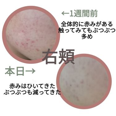 マルチビタミン 栄養機能食品 ビタミンb1 ビタミンc ビタミンe Dhcを使った口コミ 肌荒れとニキビに悩む高校生です 7日目 By ちーちょ 脂性肌 10代後半 Lips