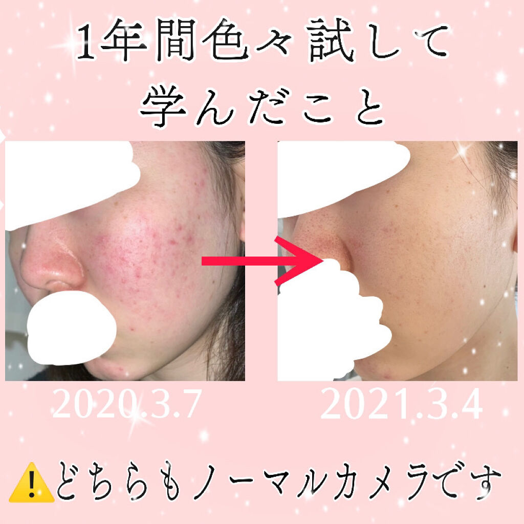 オードムーゲ 薬用ローション ふきとり化粧水 オードムーゲを使った口コミ 私は中学生の時からずーっと自分のニキビ肌 By うさぎ 乾燥肌 代前半 Lips