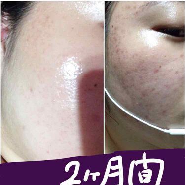 スキンケア方法 オードルックス ノーマル ｎ ドルックスの使い方 効果 ニキビ撃退 今まで By ななこ 乾燥肌 代前半 Lips