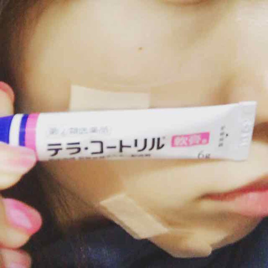 テラ コートリル 軟膏 医薬品 ジョンソン エンド ジョンソンの口コミ ニキビ解消に レビューも多くて評判も良かっ By Hizuki 混合肌 30代前半 Lips
